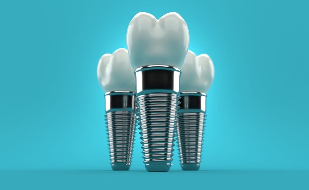 Comprehensive Guide to Dental Implant: Enhance Your Smile Today!