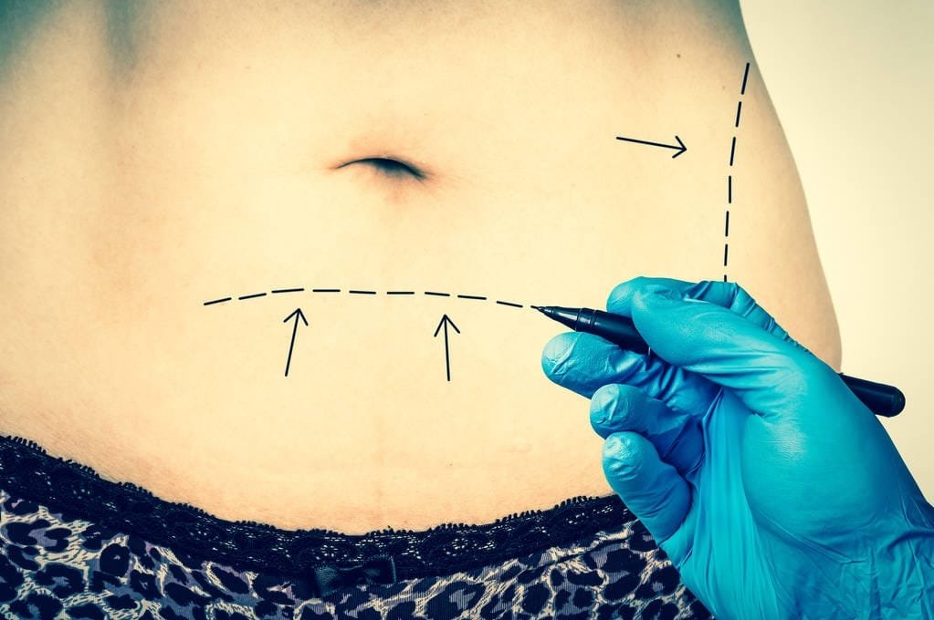 Comprehensive Guide to the Tummy Tuck Procedure